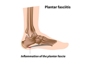 Painful Plantar Fasciitis and Finding Relief