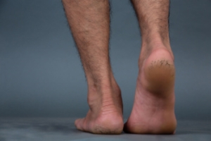 Cracked Heels Can Disrupt Daily Movement