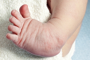 Facts About Clubfoot in Your Newborn