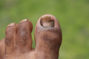 Recognizing Toenail Fungus and Its Look-Alikes